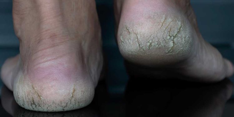 calcaie-crapate